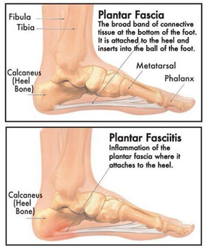 How to Heal Plantar Fasciitis Quickly  Effective Heel Pain Treatments —  Feet&Feet